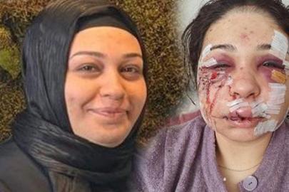 Yüzüne 60 dikiş atılmıştı! Eşini darbeden polis memuru tahliye edildi